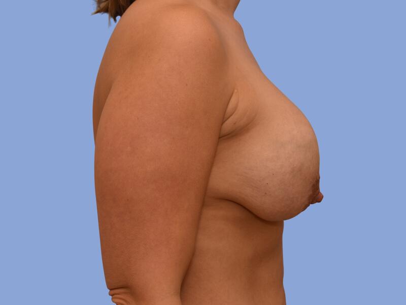 Breast lift before & after photo